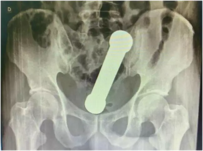 International Journal of Surgery Case Reports