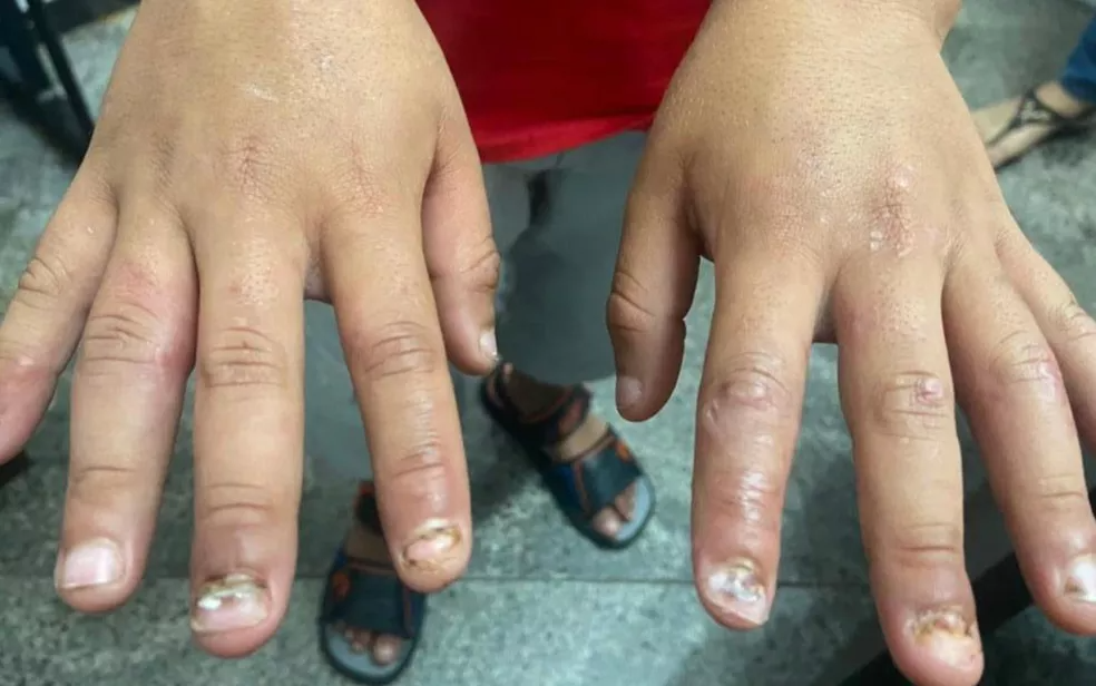 Menino de 8 anos exibe unhas que foram arrancadas durante sessões de tortura em Goiânia — Foto: Divulgação/Polícia Civil