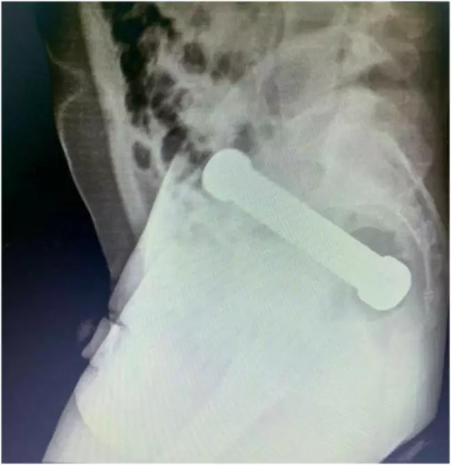International Journal of Surgery Case Reports