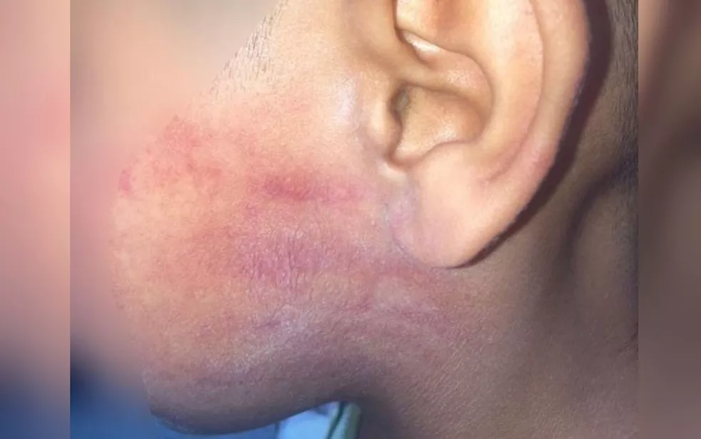 Menino de 6 anos ficou com hematoma após apanhar do pai com  chineladas no rosto, em Goiânia — Foto: Polícia Civil/Divulgação 