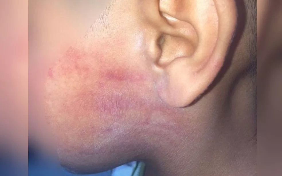 Menino de 6 anos ficou com hematoma após apanhar do pai com chineladas no rosto, em Goiânia — Foto: Polícia Civil/Divulgação