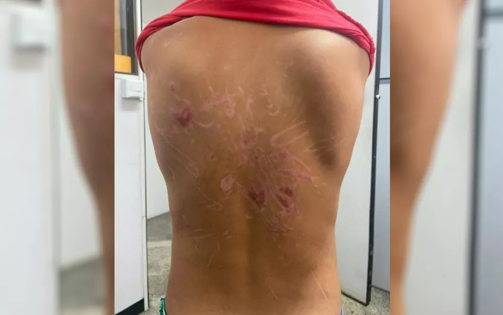 Menino de 8 anos exibe ferimentos nas costas que sofreu após sessões de tortura, em Goiânia — Foto: Divulgação/Polícia Civil