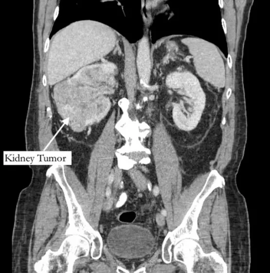 Homem vai tratar dor no dedão do pé e descobre tumor em fase terminal